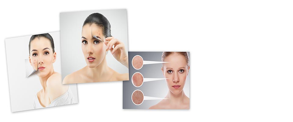 Main - Acne Treatment