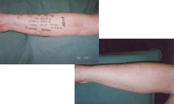 tattoo removal laser tattoo removal laserase croydon tattoo removal laser tattoo removal laserase croydon